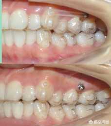 矯正牙齒是帶牙套好，還是手術矯正好？